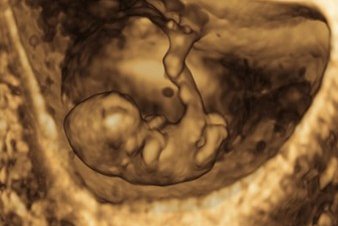 3D ultrasound