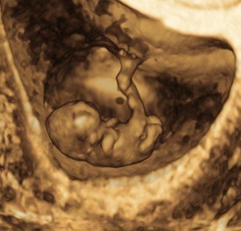 3D ultrasound