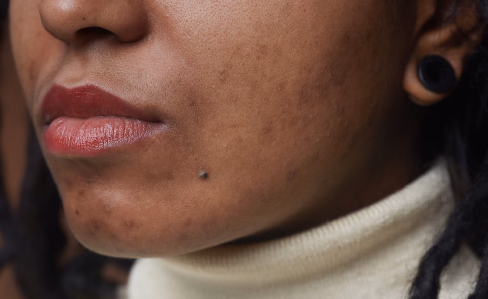 Black woman with acne scars